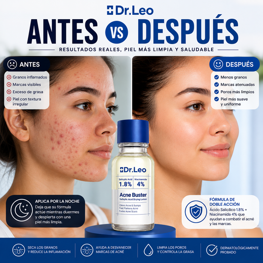 Dr. Leo Ácido Salicílico Acne Buster – Tratamiento Secante para el Acné y las Imperfecciones